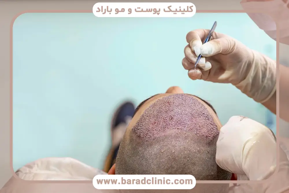 بررسی ارتباط روزه و کاشت مو 