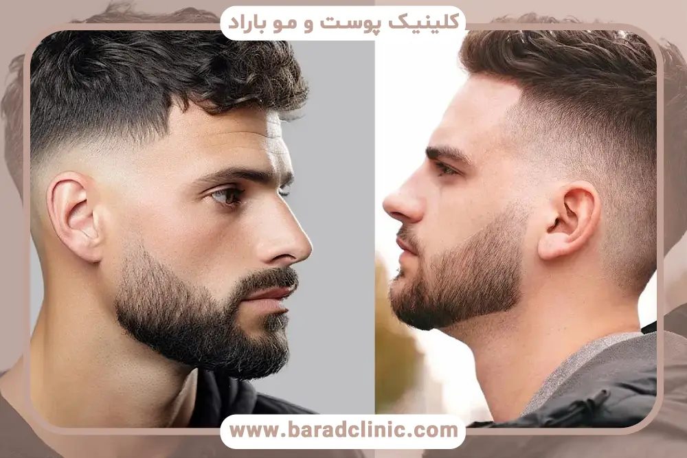 بررسی تعرفه کاشت مو 