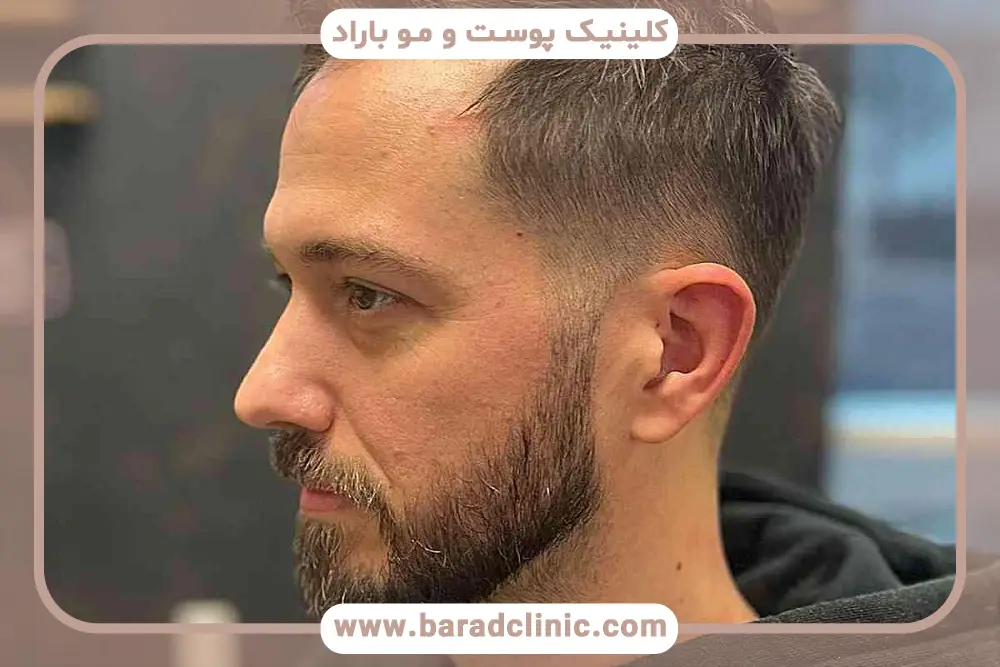 کمبود مواد غذایی دیگر علت کم پشتی ریش 