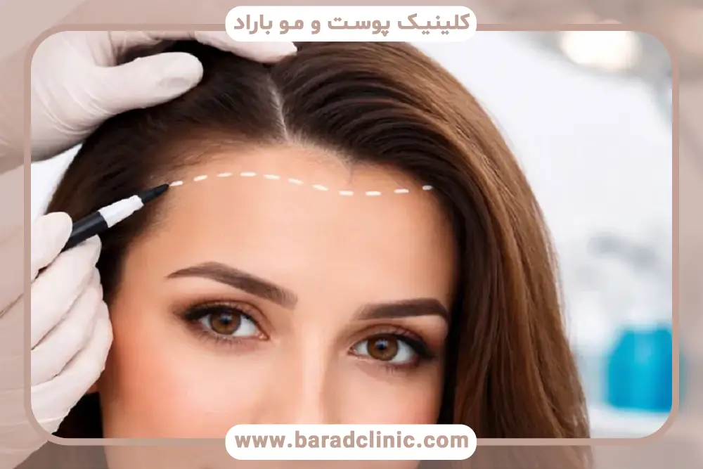 تاثیر تعداد گرافت روی قیمت کاشت مو برای خانم ها