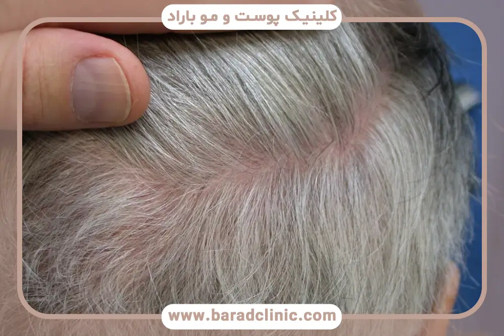 دلایل شوک ریزش مو بعد از کاشت