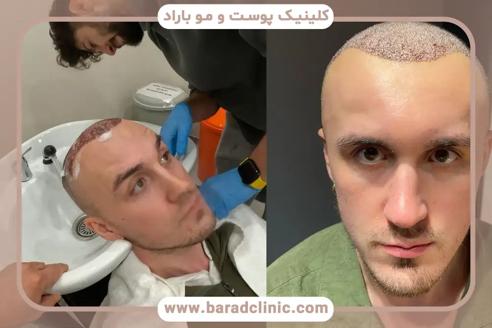 نحوه مصرف زینک بعد از کاشت مو