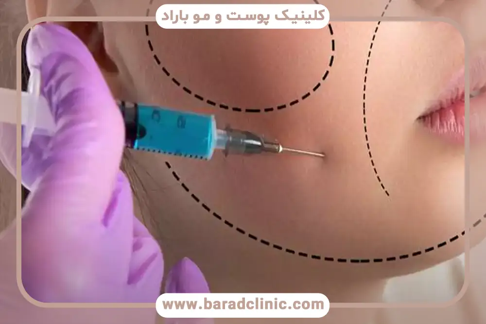 مزایای لاغری مزوتراپی 
