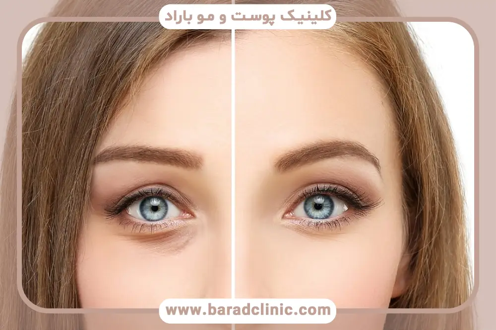 کم کاری تیروئید و عمل بلفاروپلاستی، بررسی عوارض