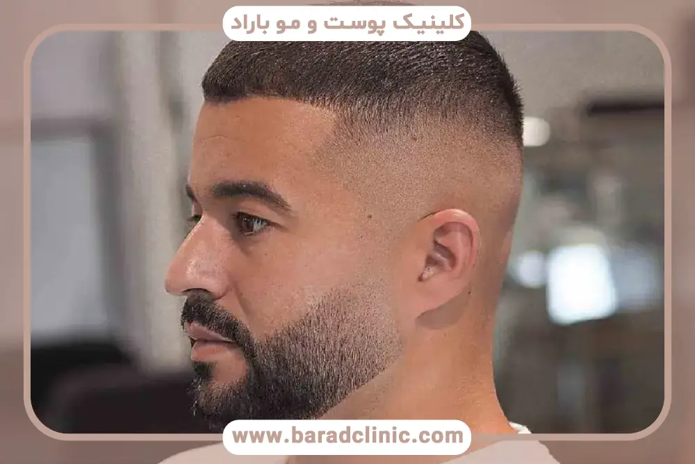 کاندیدای مناسب کاشت مو سریع