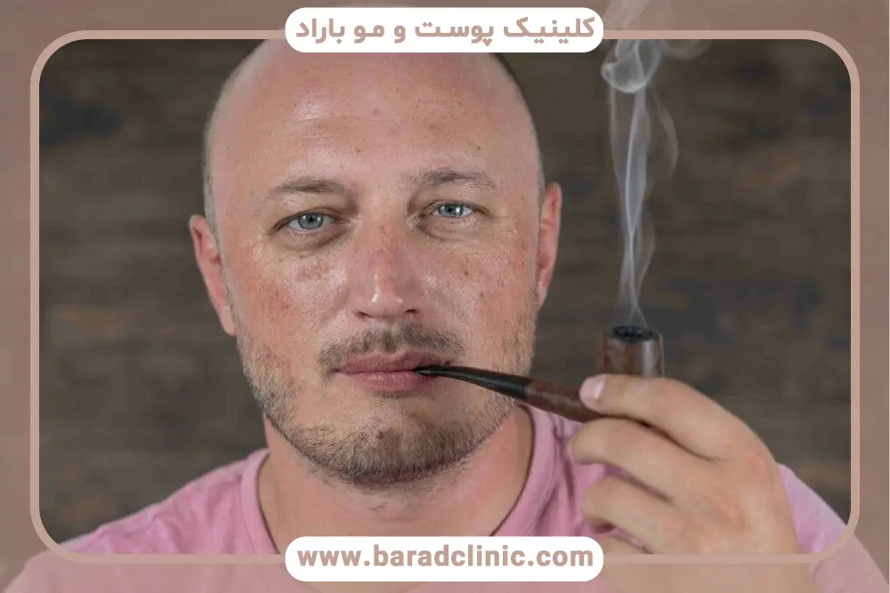 اثرات فیزیولوژیک سیگار بر جریان خون پوست سر