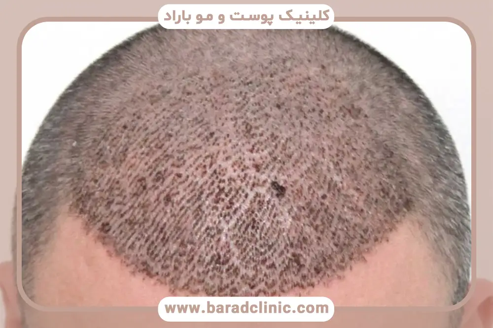 ترکیبات تونیک بعد از کاشت مو 