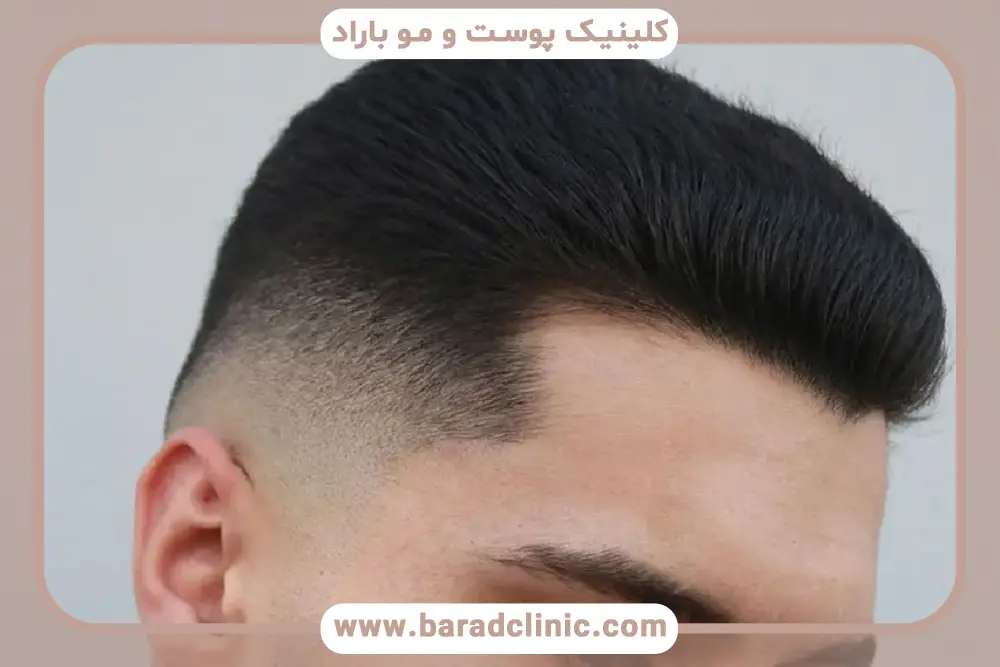 مراحل روش کاشت مو میکرو ایمپلنت 