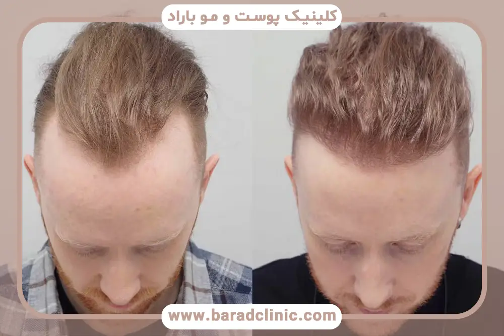عوامل موثر بر هزینه کاشت مو به روش ترکیبی