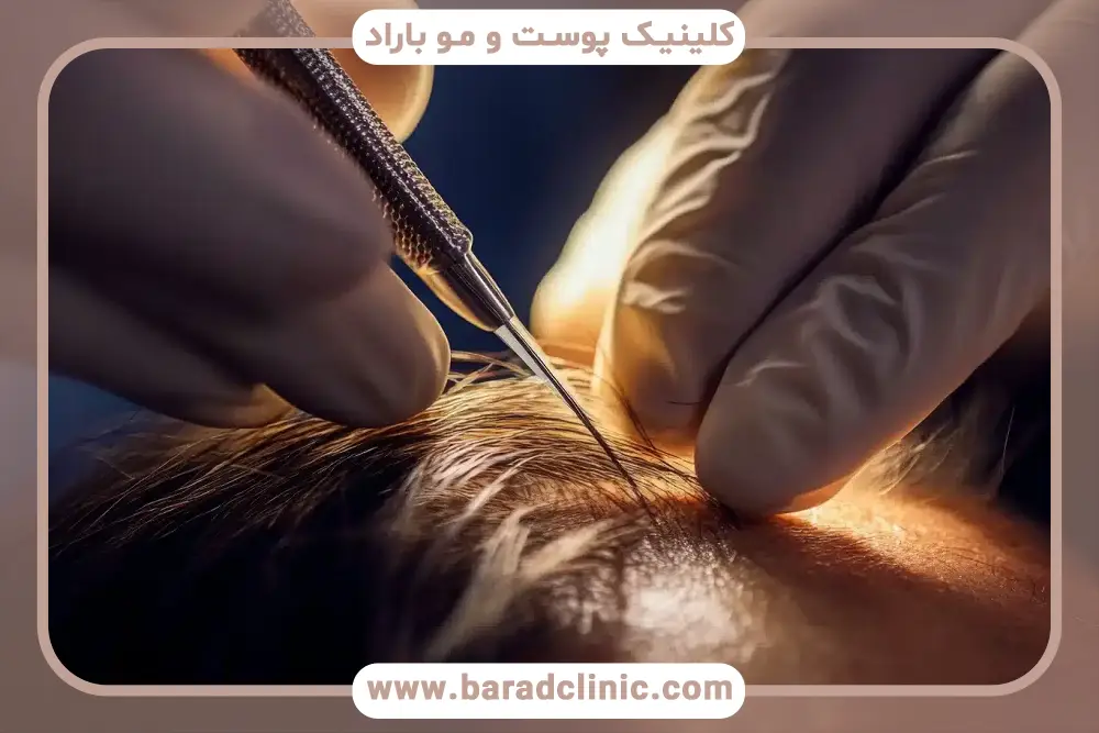 بررسی مراحل کاشت در فیلم کاشت مو از نزدیک 