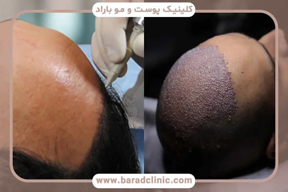 تاثیر نوع هپاتیت روی کاشت مو