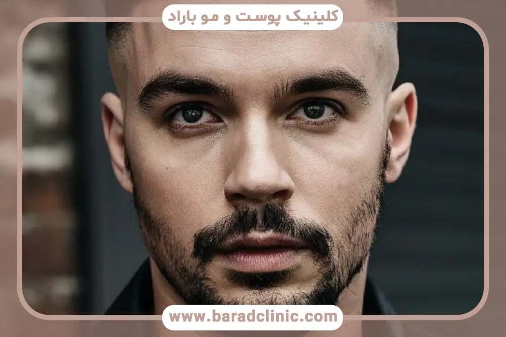 تاثیر روش انتخابی روی هزینه کاشت ریش تار به تار