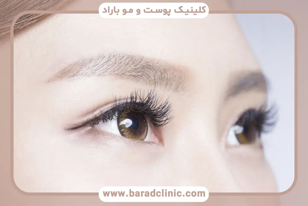 مراحل عمل بلفاروپلاستی چشم شرقی 