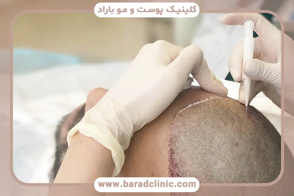 روشهای کاشت مو در یک جلسه