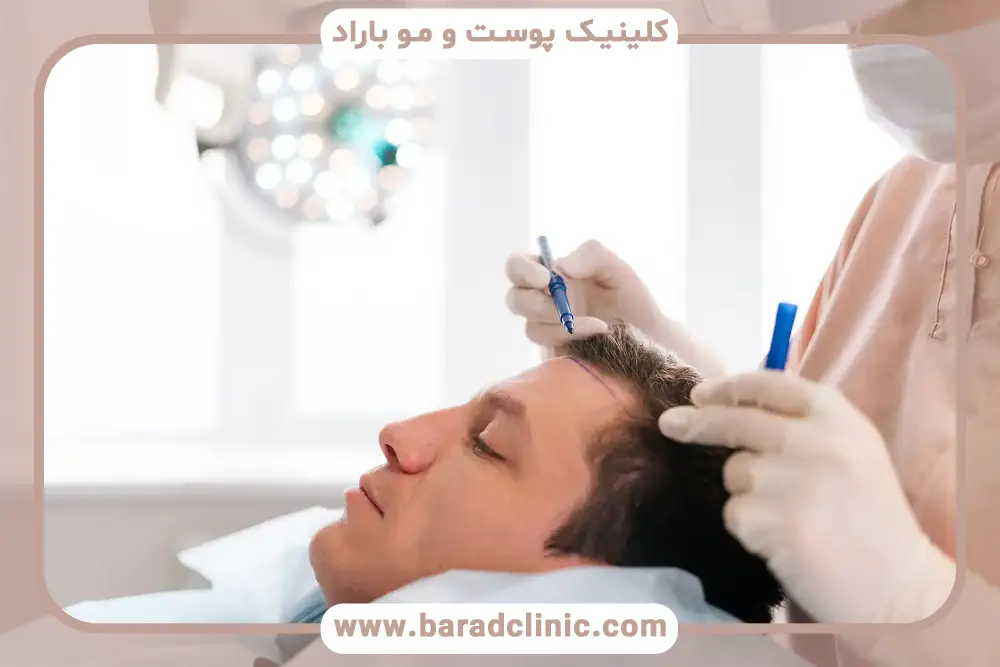 جدیدترین روش‌های کاشت در کلینیک کاشت مو مدرن 