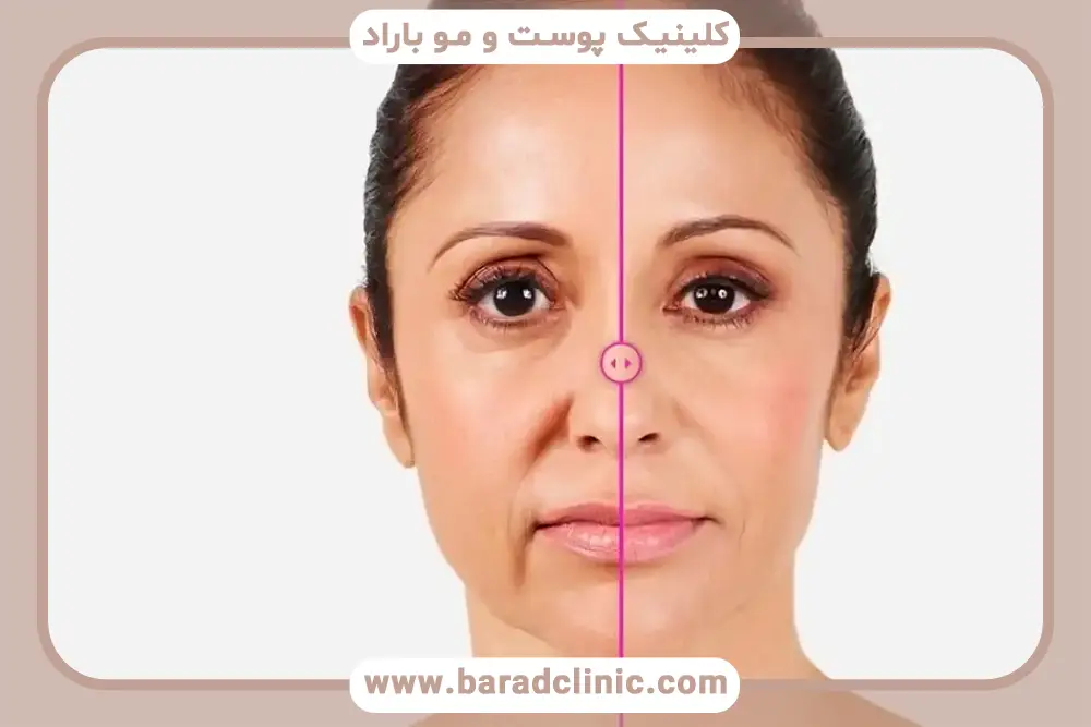 مزایای prp خط خنده 