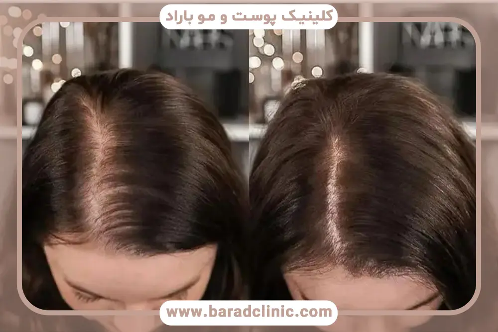 بهترین روش کاشت مو جلوی سر زنان 