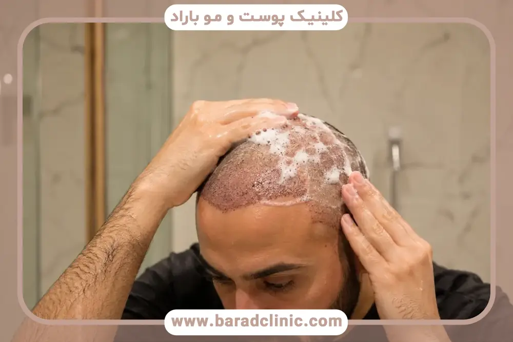 چند روز بعد از کاشت مو شروع به ریزش میکند؟ بررسی مدت زمان ریزش