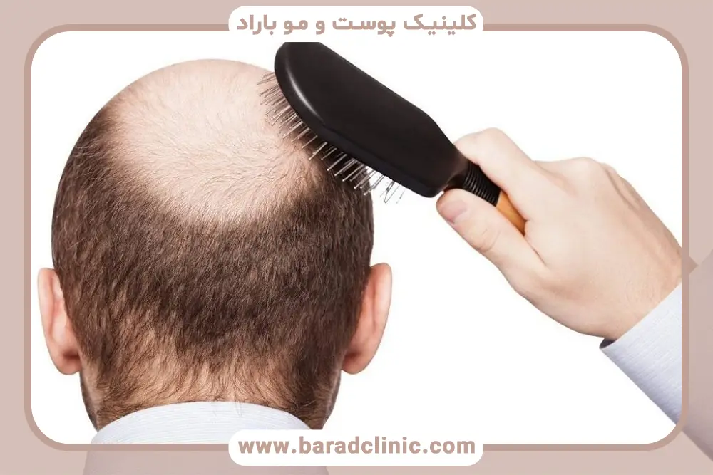 جدیدترین روش‌های کاشت مو برای افراد کاملا طاس 