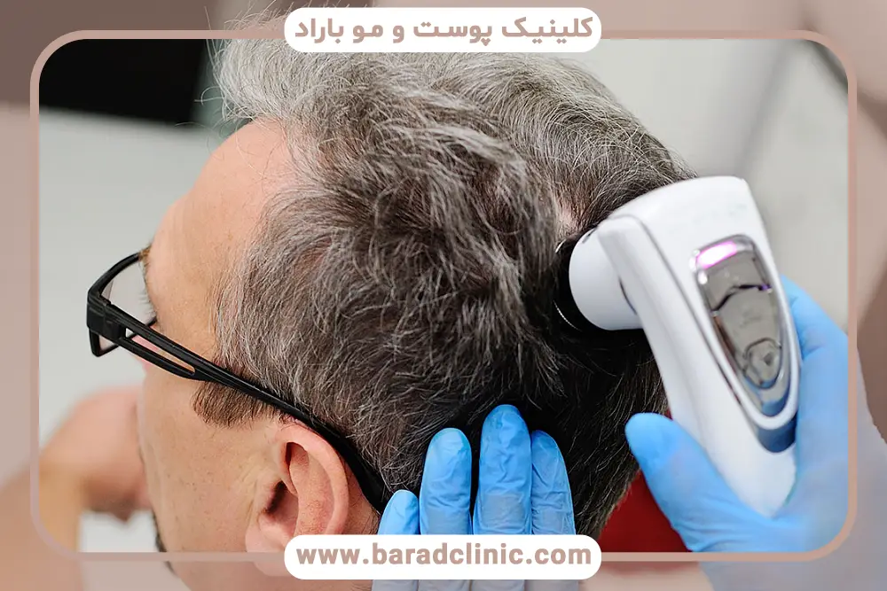 کاندید مناسب مشاوره آنلاین کاشت مو