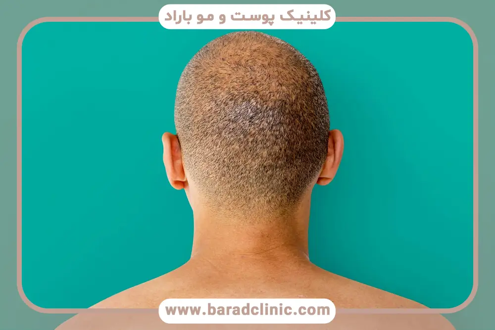 مدت زمان شوک ریزش مو بعد از کاشت