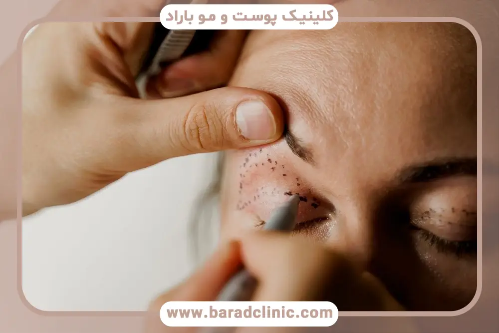 طبیعی بودن سوزش چشم بعد از بلفاروپلاستی