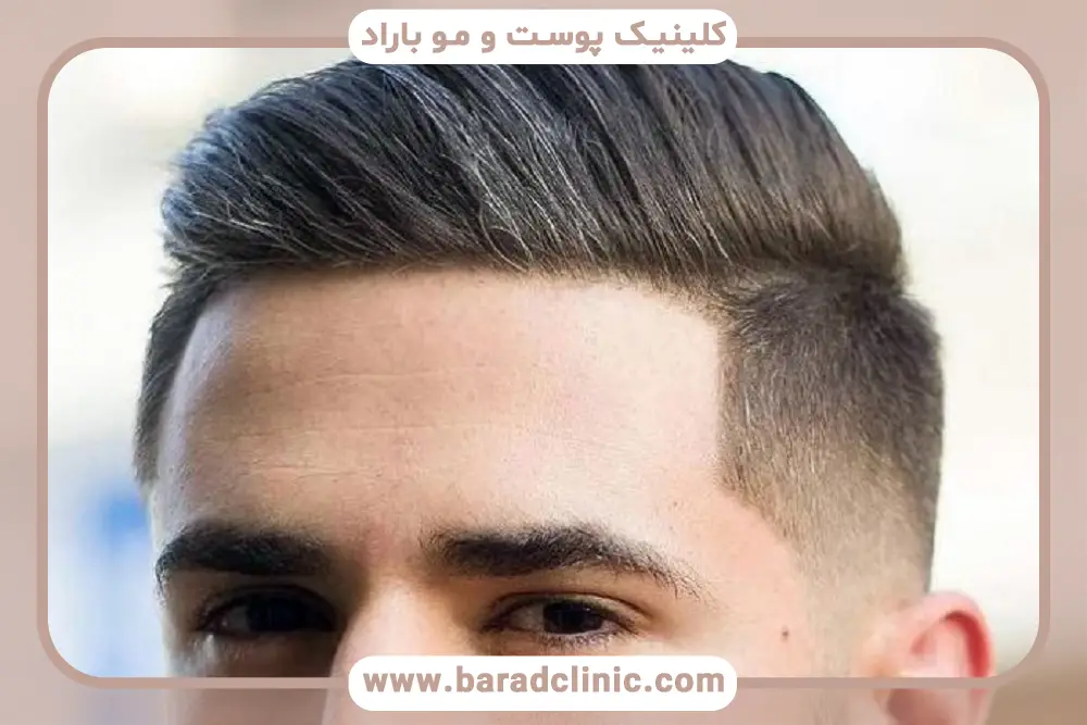 دوره نقاهت کاشت مو سریع