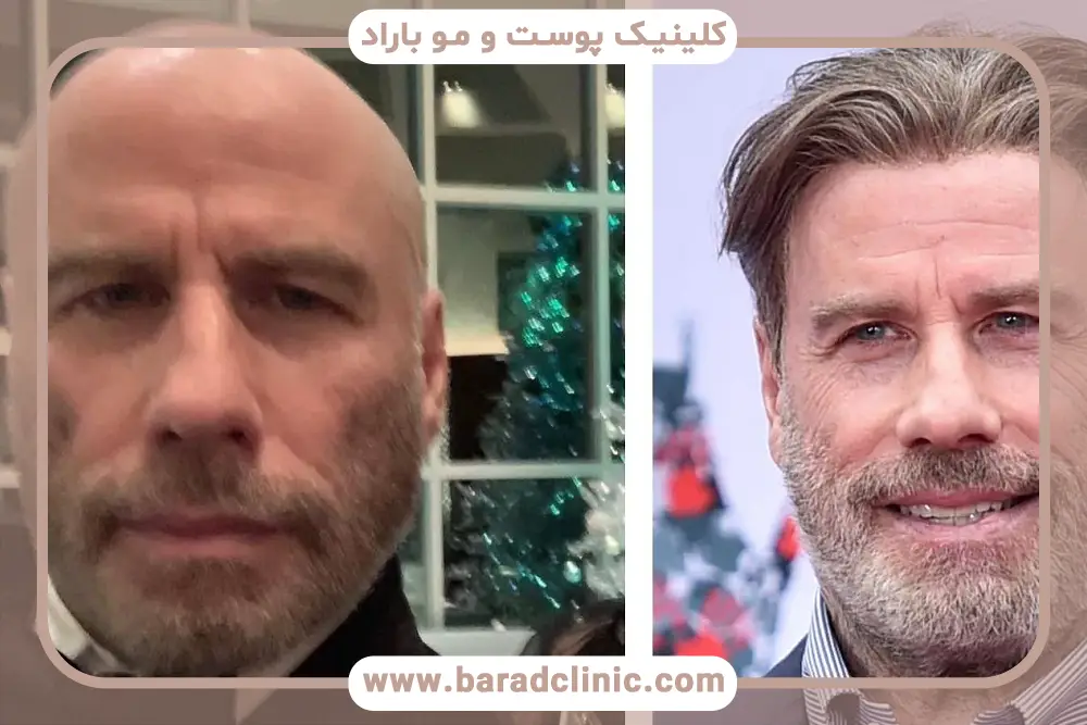 هزینه کاشت مو بازیگران