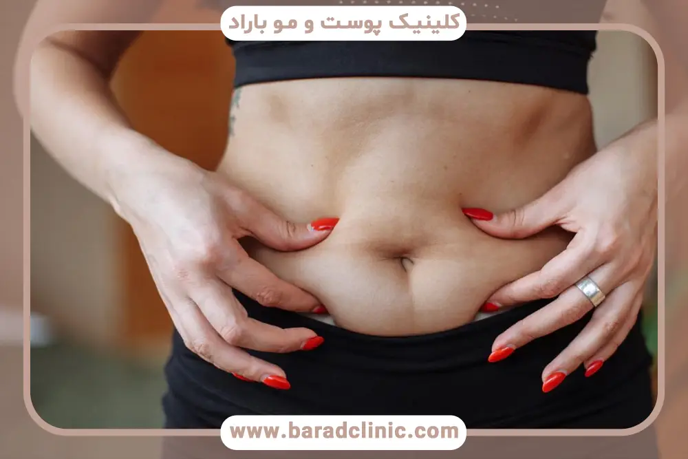 عوارض احتمالی کرایو لاغری چیست