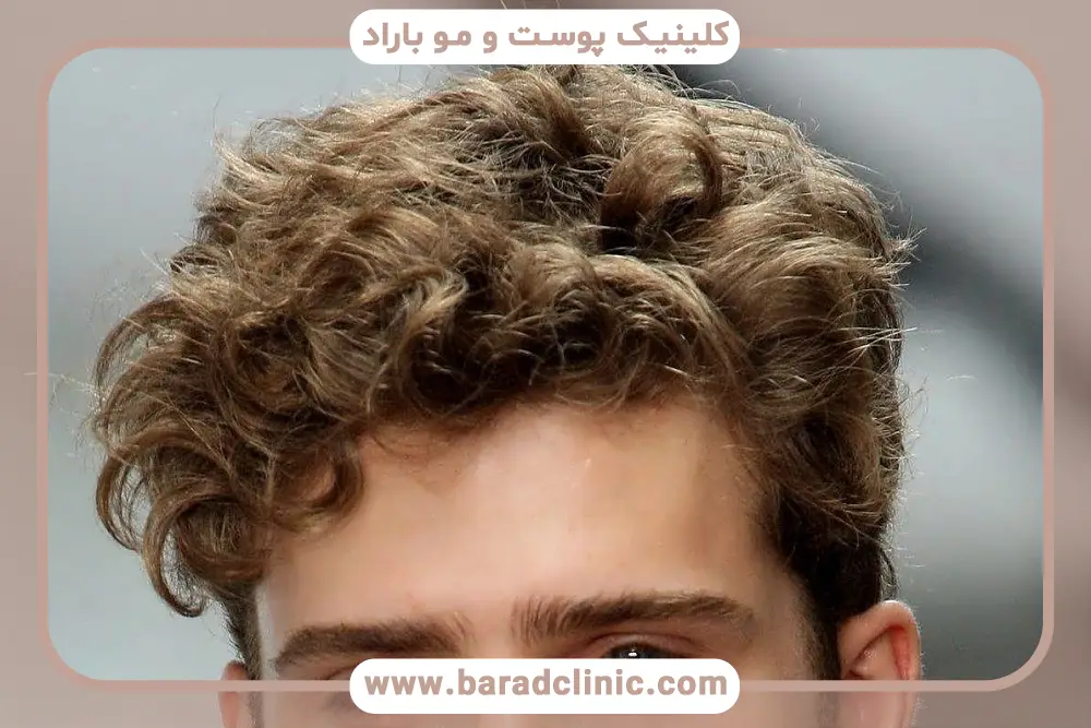 میزان تراکم روش کاشت مو میکرو ایمپلنت 