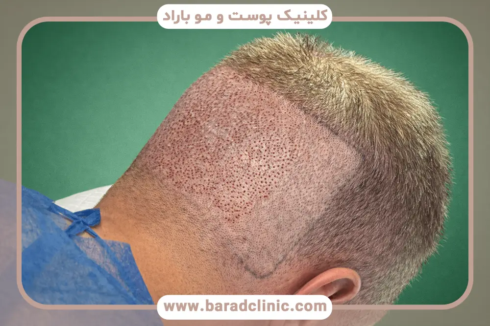 تاثیر خدمات قبل و بعد در هزینه کاشت مو به روش ترکیبی