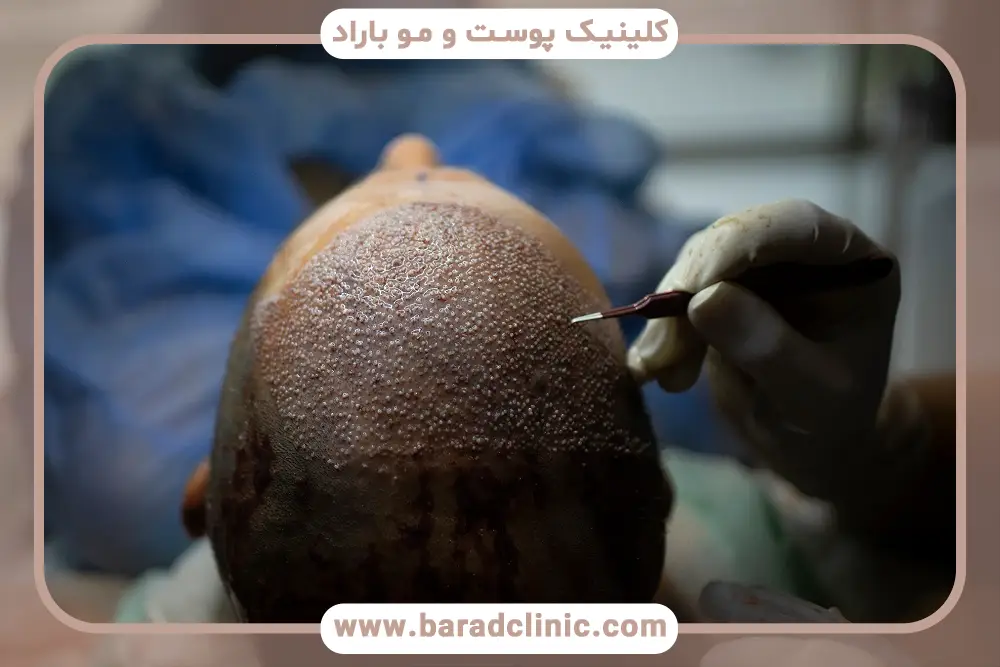 نکات قبل از تماشای فیلم کاشت مو از نزدیک 
