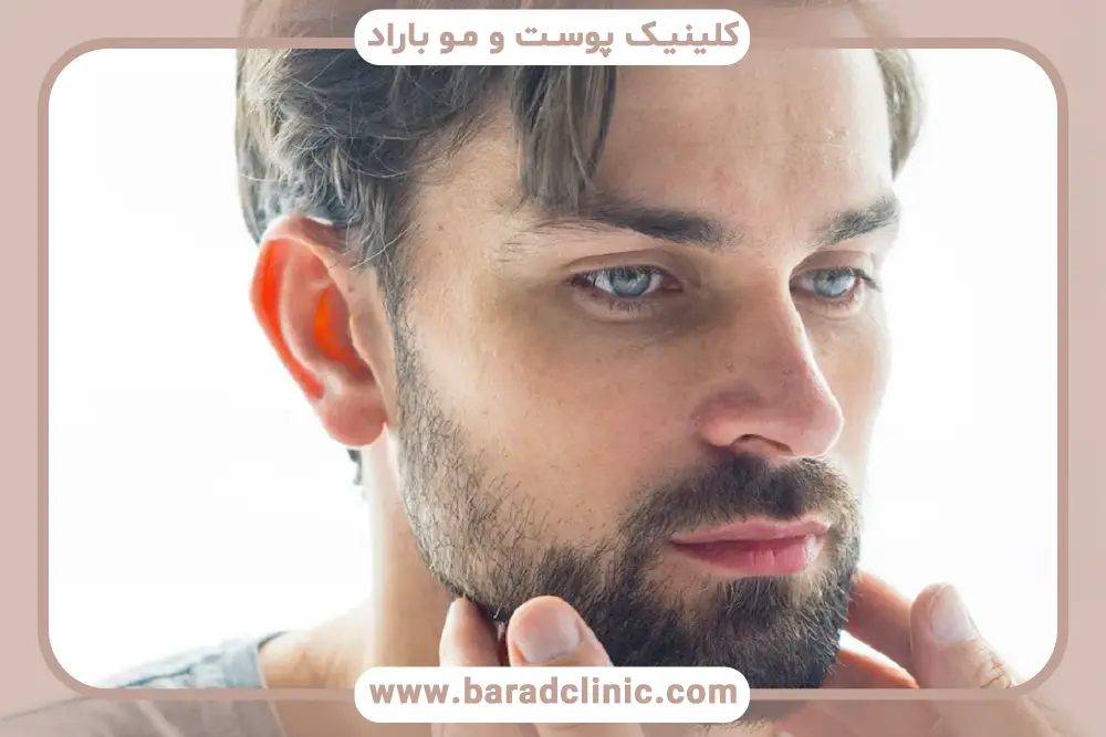 مراقبتهای بعد از کاشت ریش تار به تار