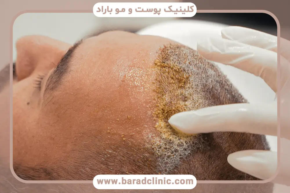هپاتیت و کاشت مو، بررسی نکات ایمنی
