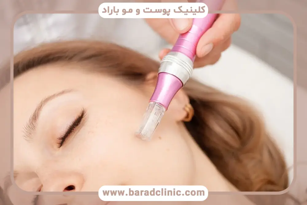 مزوتراپی بهتره یا میکرونیدلینگ؟ بررسی عوارض جانبی