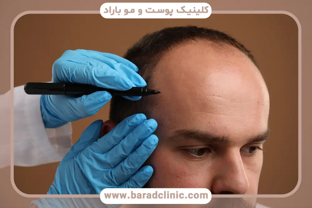 مزایا و معایب کاشت مو در یک جلسه