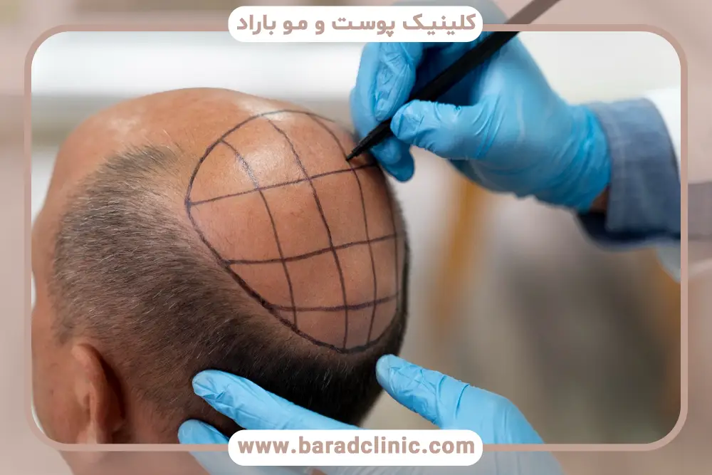 مراقبت‌های قبل و بعد کاشت مو