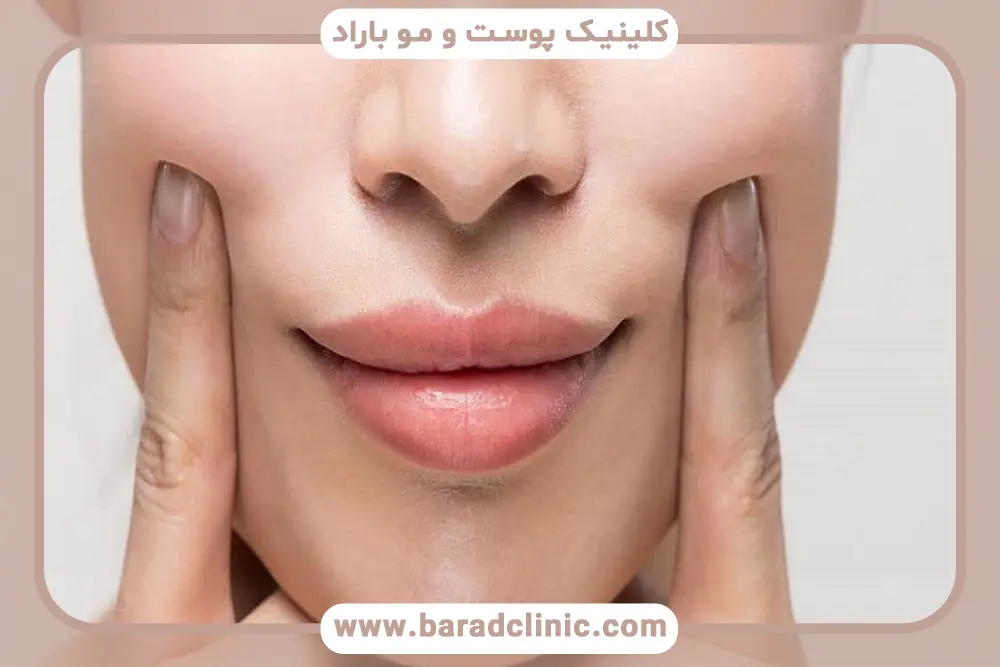 مراقبت‌های قبل و بعد prp خط خنده 