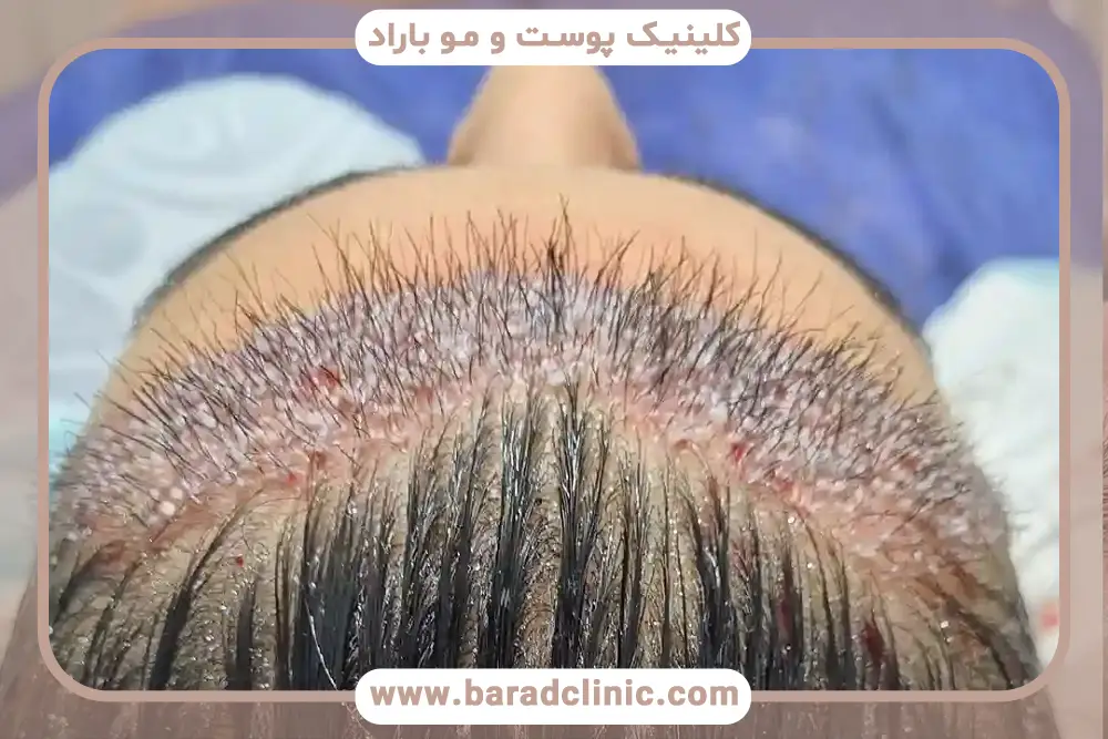 مزایای کاشت مو جلوی سر زنان 
