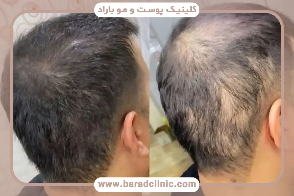 تاثیر روش انتخابی روی هزینه کاشت مو برای موهای کم پشت 