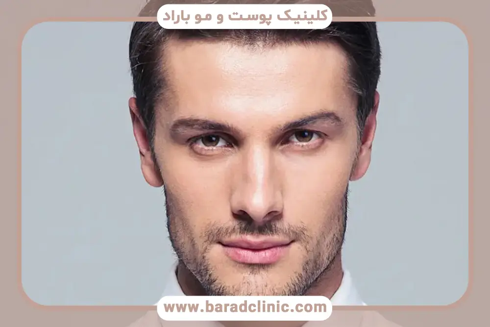 مراقبت‌های بعد از کاشت ریش فوری 