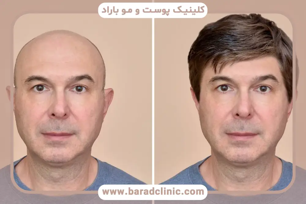 محدودیت‌های کاشت مو برای افراد کاملا طاس 