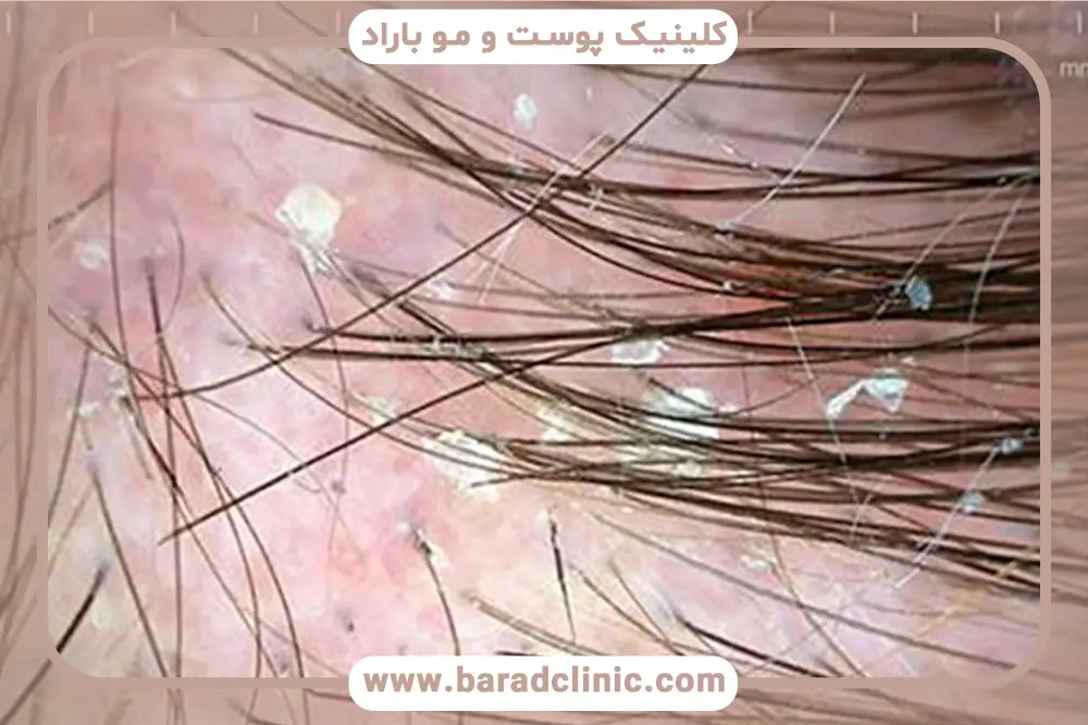 بیماری‌های پوست سر و طاسی