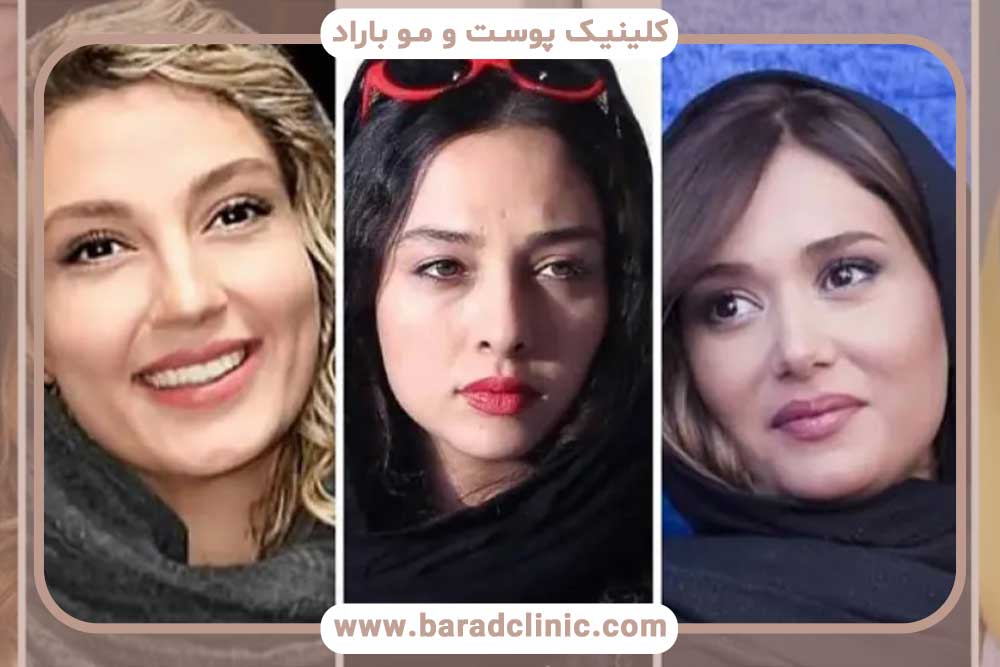 کاشت ابرو در بازیگران