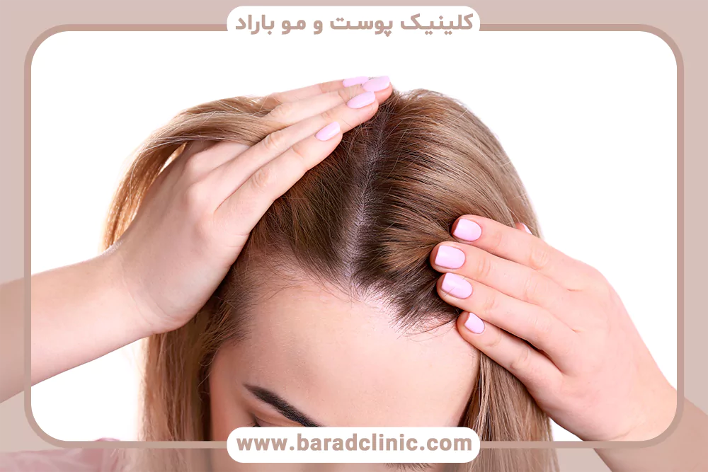 درمان ضدالتهاب ریزش مو