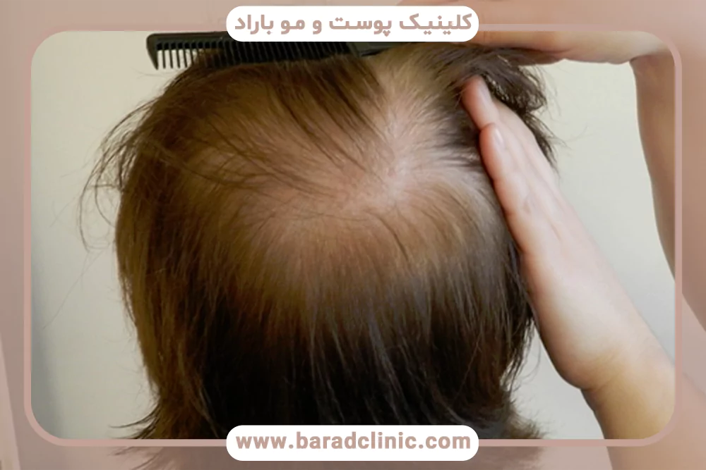 ریزش مو در زنان