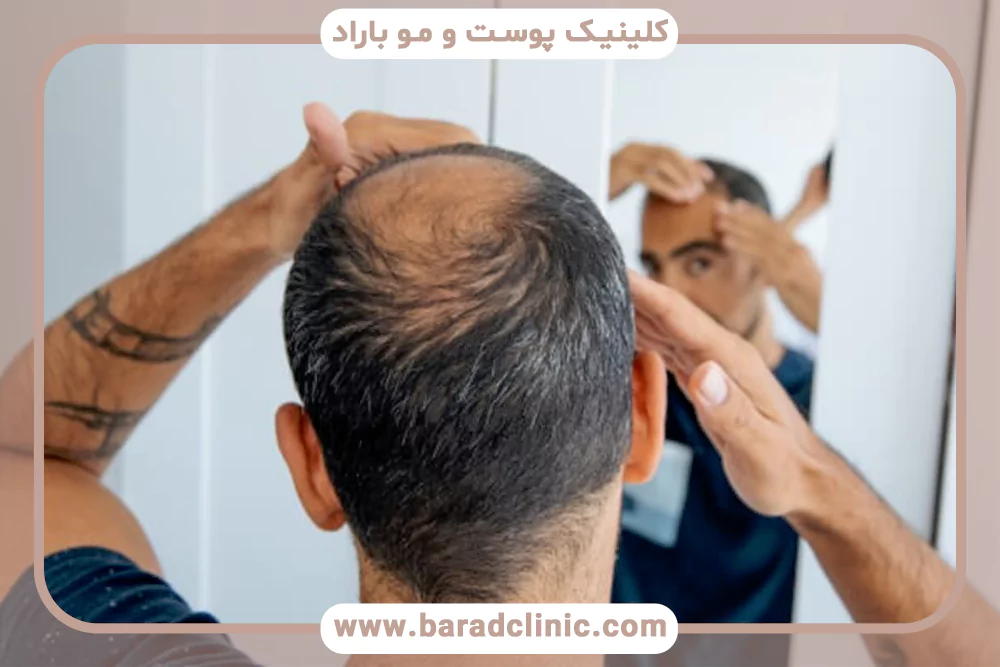 حمله سیستم ایمنی به مو