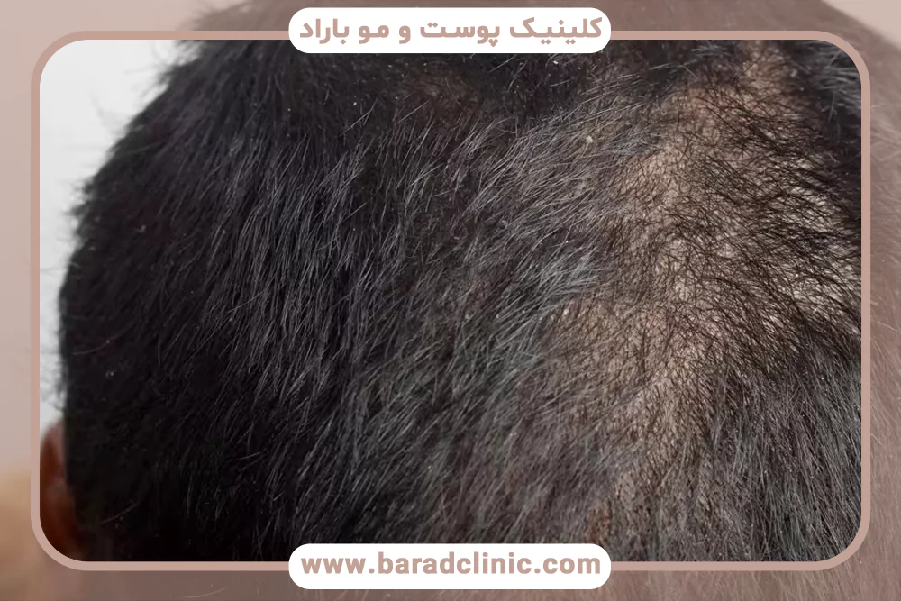 بیماری‌های پوست سر و طاسی