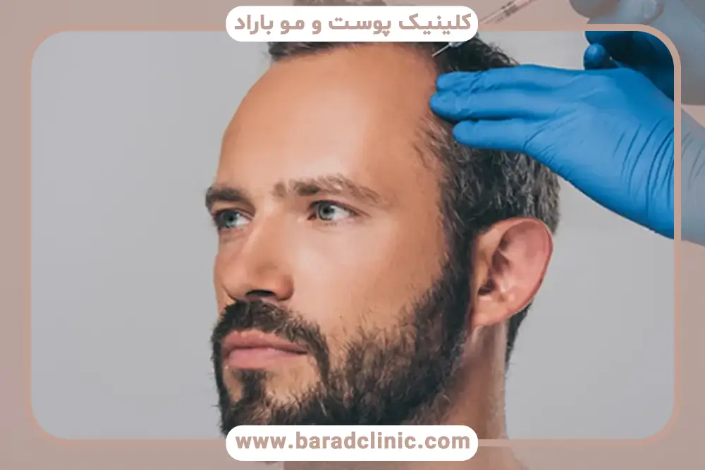 بهترین مکمل بعد از کاشت مو
