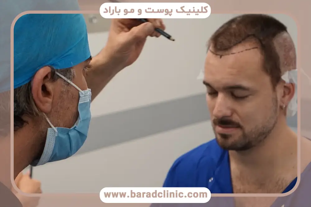 هزینه کاشت مو با نیدل